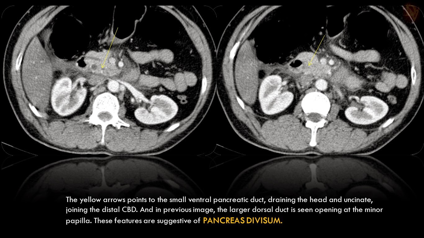 Ultimate Radiology : Acute Pancreatitis with hemorrhage and Pancreas