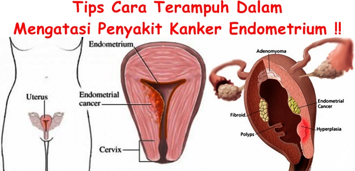 Obat Tradisional Kanker Endometrium
