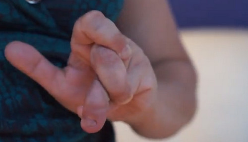 Ehlers-danlos syndrome signs and symptoms, genetics, diagnosis Ehlers Danlos Syndrome Pictures | Medical Pictures and Images - (2020