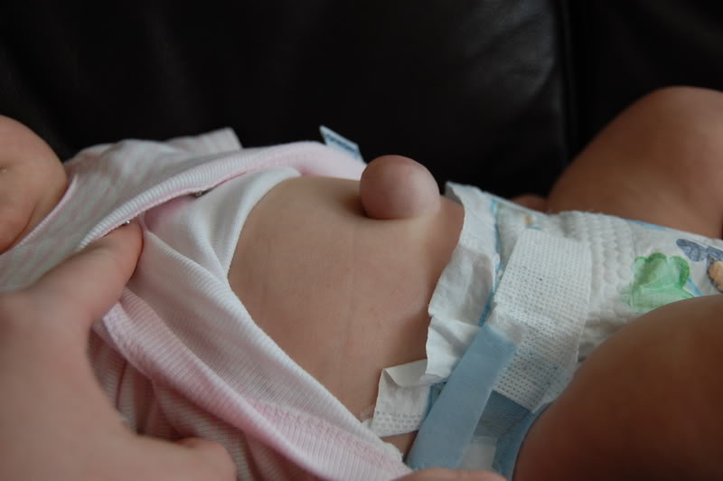 Bebés nacidos con arteria umbilical única