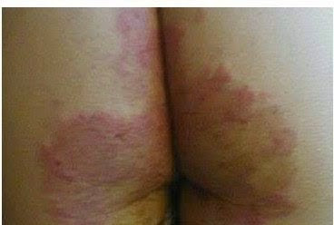 Image Eksim di pantat terasa gatal