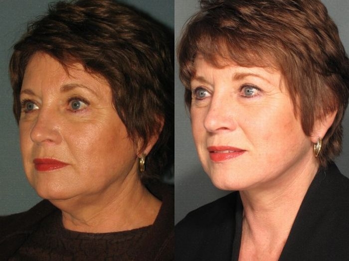 Face Aerobics Exercises To Tone And Tighten Slack Face Skin Sharpen