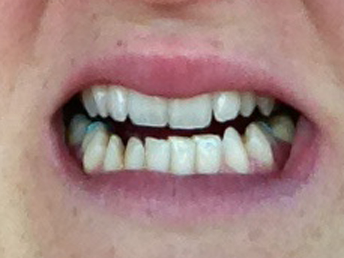 The 80s called. . . About the braces (with grotesque pics)