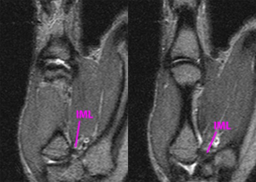 MRI Musculo-Skeletal Section: Thumb carpo- metacarpal joint.