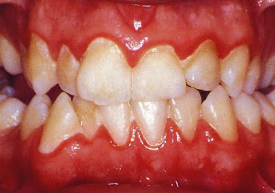 Mẹo giảm đau viêm chân răng hiệu quả-1