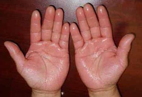 Hiperhidrosis pada telapak tangan
