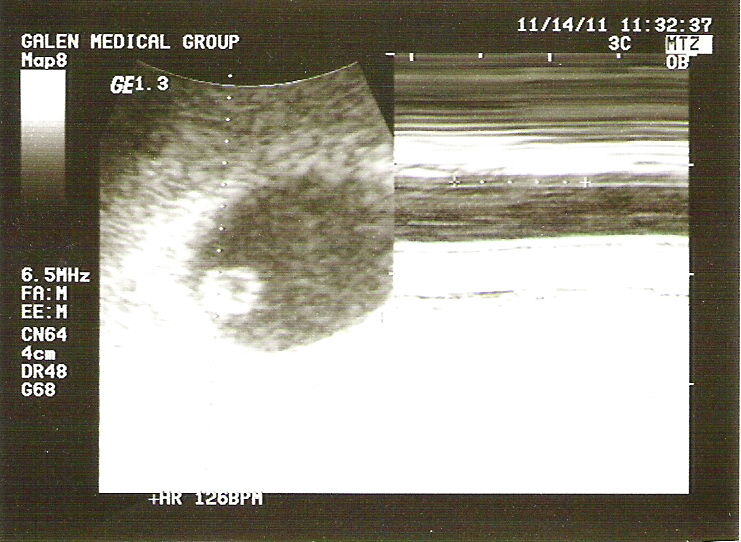 normal heart rate at 6 weeks normal heart rate at 6 weeks