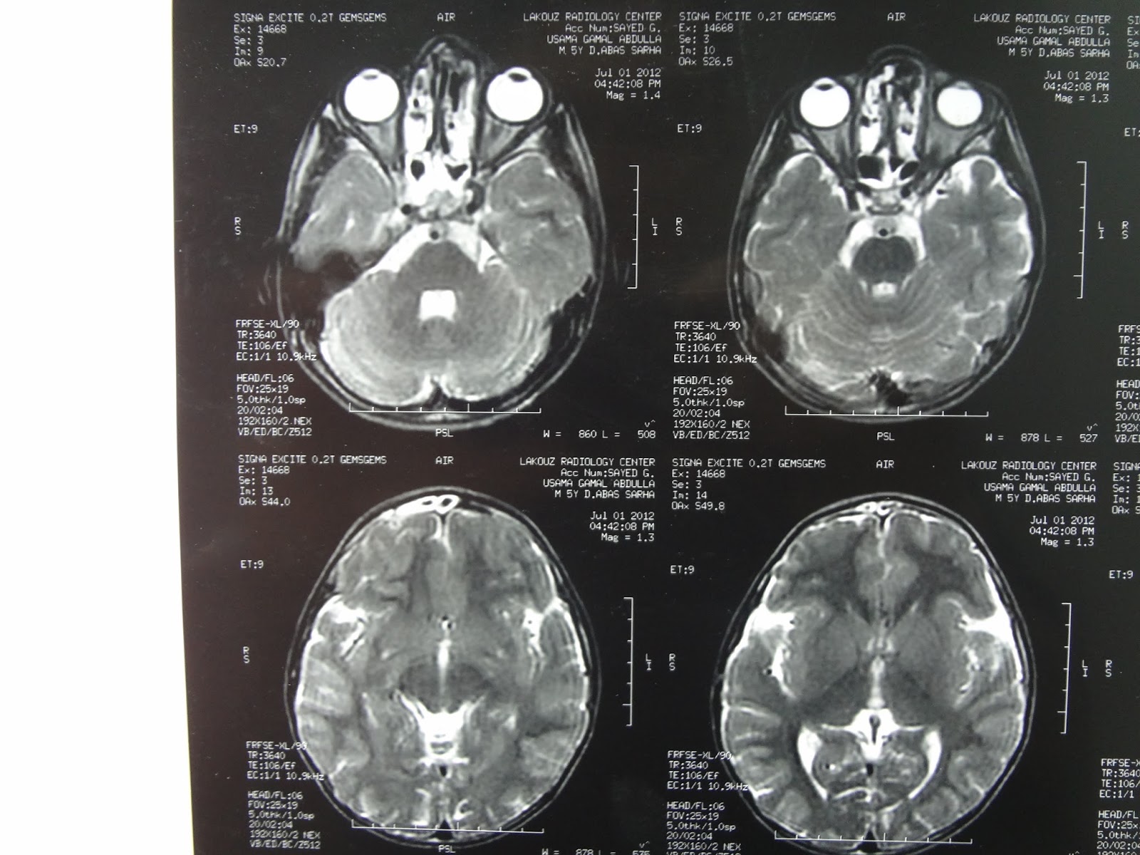 neuroectodermal tumor of the nose , CT and MRI of nasal cavity