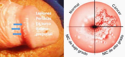 que significa papiloma en medicina