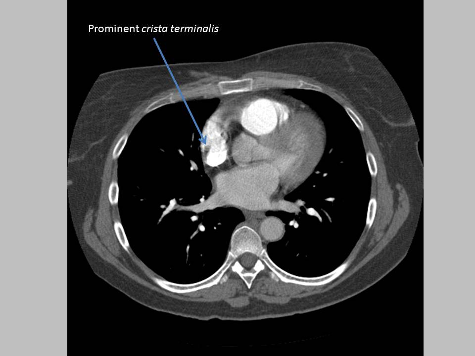 The Pump and the Tubes Crista Terminalis