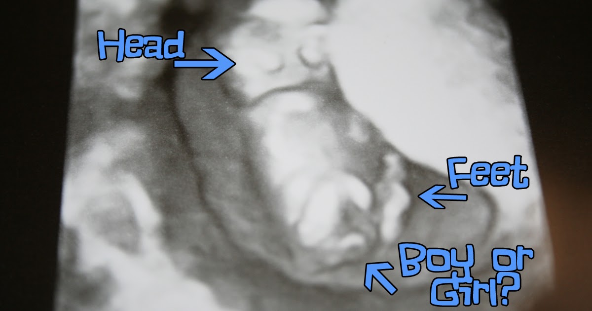 The Infertility Overachievers: Nuchal Translucency Ultrasound