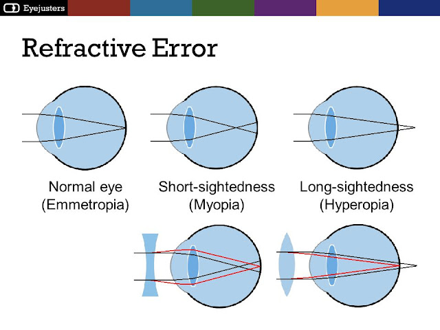 Refractive Errors and optical maser Vision Correction