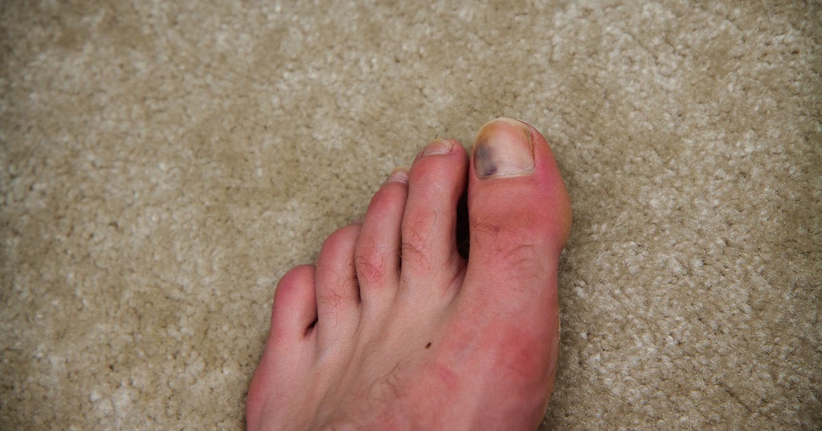 black toes 1