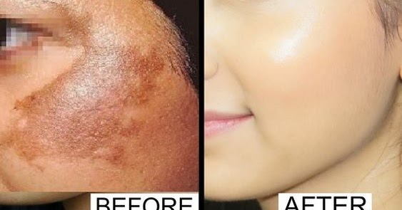 Remove Dark Spots and Acne Scars From Face