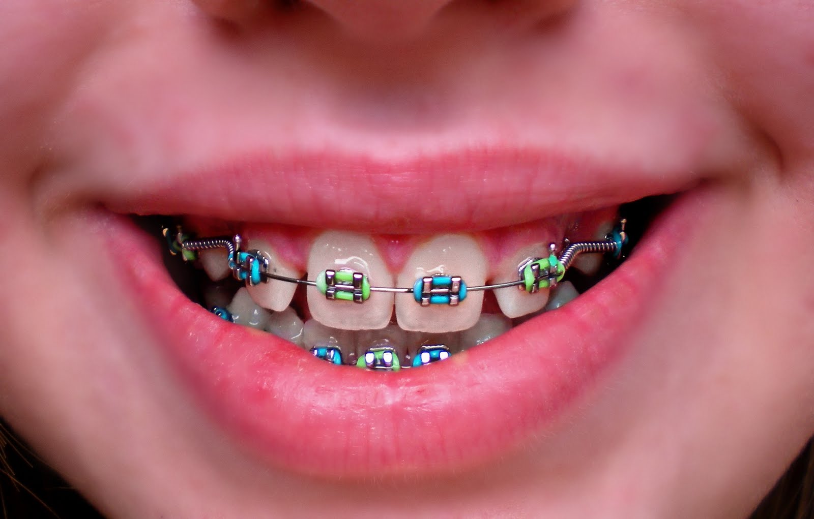 Брекеты на зубы для детей сколько стоят. Металлические брекеты. Металлические брекеты детям. Красивые детские брекеты.