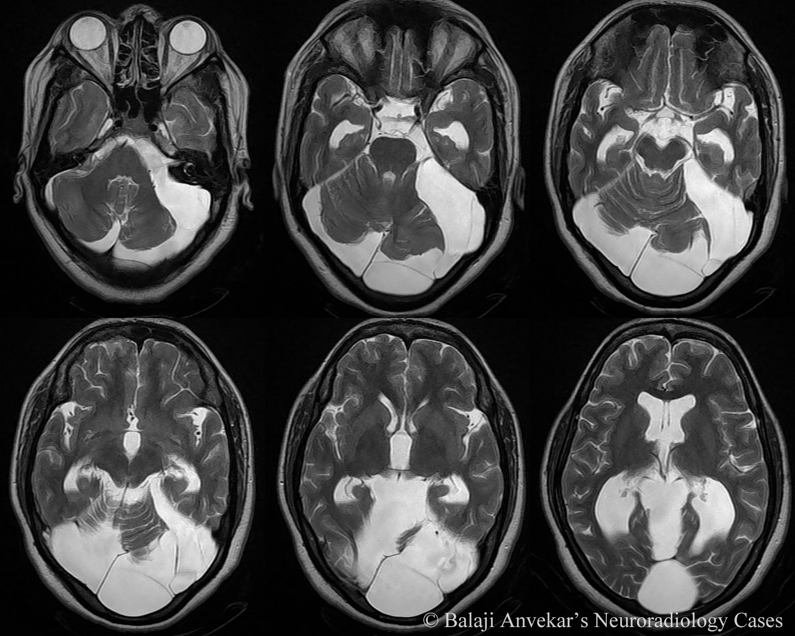 Dr Balaji Anvekar FRCR: Posterior Fossa Arachnoid cyst MRI
