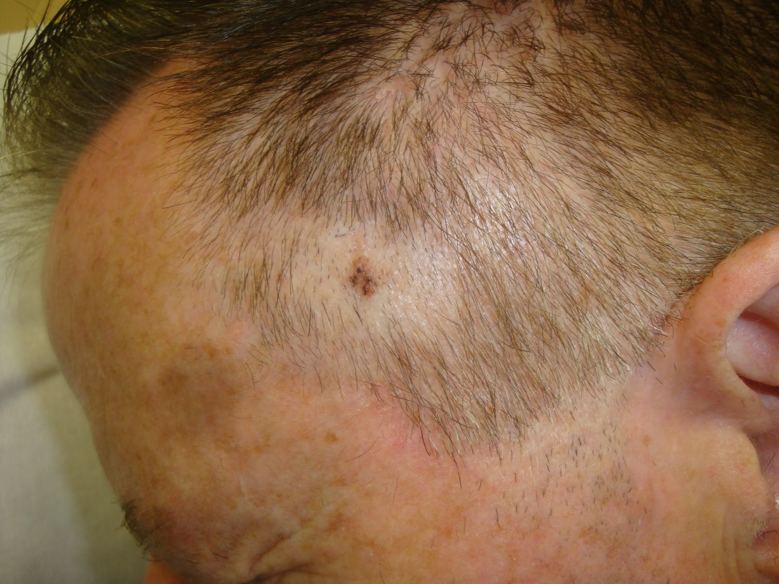 melanoma-scalp