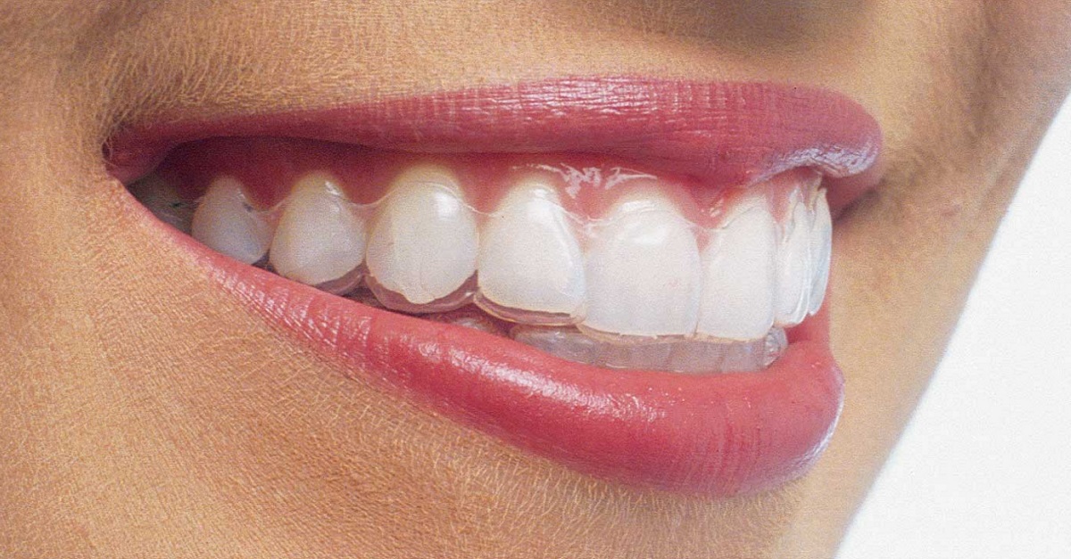 Murfree Dental The process of installing Invisalign