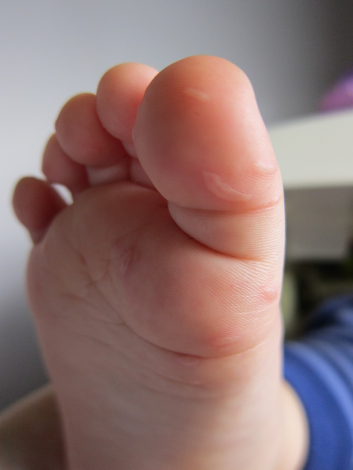 Pictures and Symptoms of Hand Foot and Mouth Disease