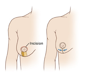 Breast Reduction Surgery, Liposuction, Vertical Breast Reduction, Inverted-T Breast Reduction,breast reduction,breast reduction gold coast,breast reduction surgery