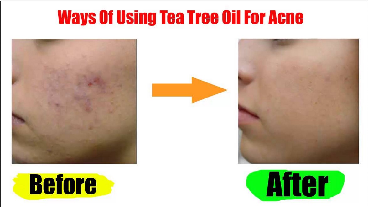 Warum Funktioniert Teebaumol Gegen Akne