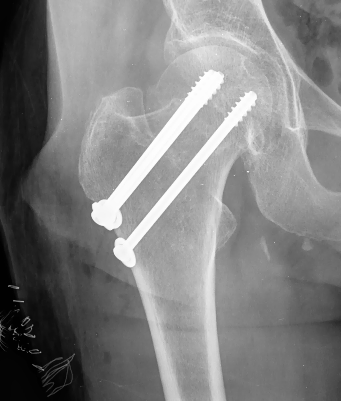 Fractura do colo do fémur a direita, tipo Garden I e seu tratamento cirurgico Enfermagem em Fractura do colo do fémur a direita, tipo Garden I e seu tratamento cirurgico Enfermagem em