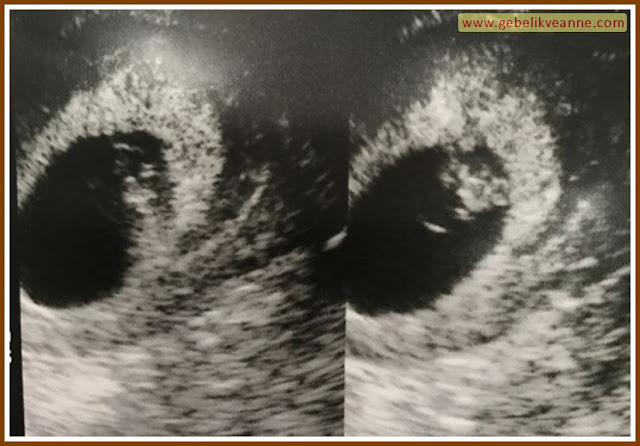 9 haftalık gebeliğin ultrason görüntüsü