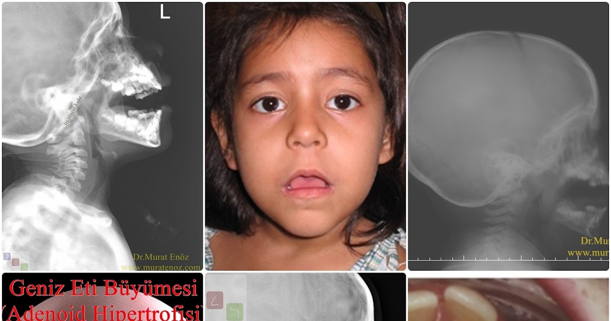 Geniz Eti Buyumesine Bagli Olarak Ortaya Cikabilecek Dentofasyal Anomaliler