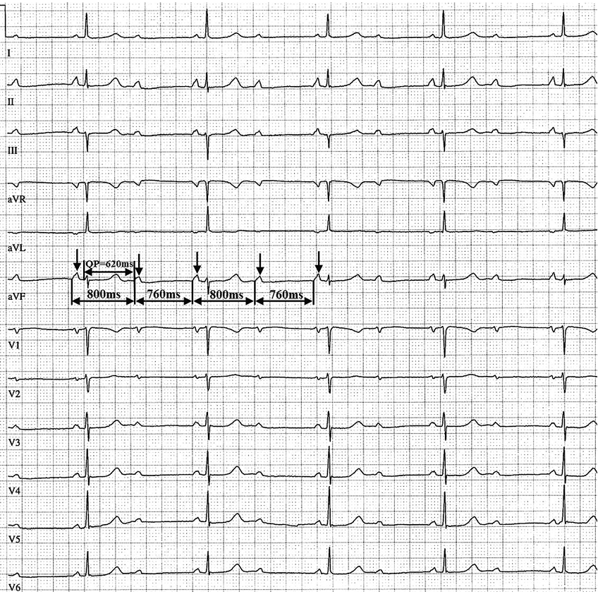 Блог по ЭКГ: Вентрикулофазовая синусовая аритмия