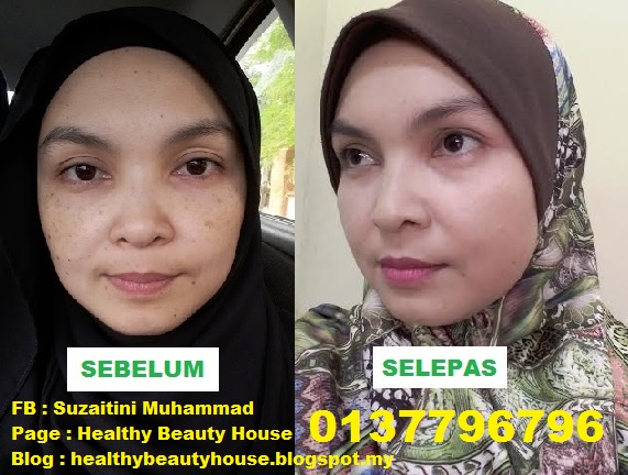 CARA CEPAT HILANGKAN JERAGAT DI MUKA DENGAN SET JERAGAT SHAKLEE. RAMAI