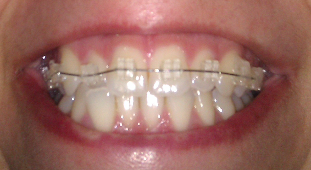 Porque ponen gomas brackets