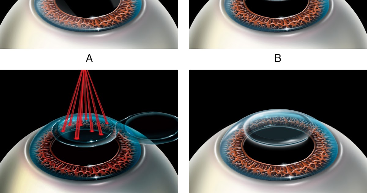 Фемто и каска. Lasik лазерный кератомилез. Супер фемто. Метод ласик. Лазерная операция femto lasik.