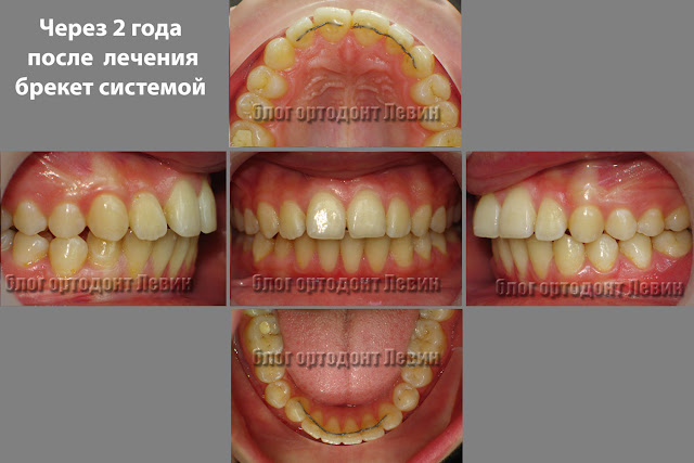 Пример пациента с поломкой ретейнера Пациент с рецидивом лечения и поломкой ретейнера