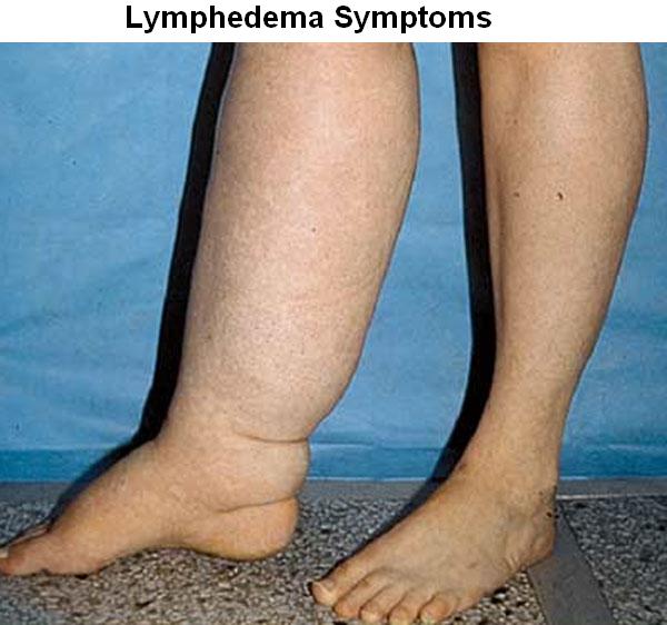 List 94 Pictures Pictures Of Lymphedema In Legs Superb