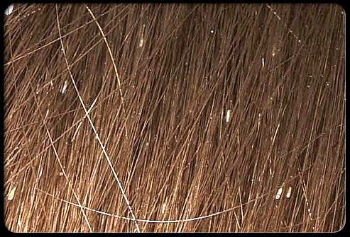 Cara Menghilangkan Kutu rambut