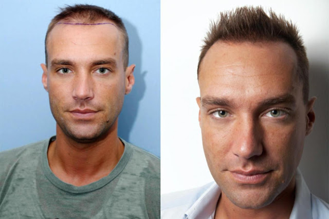 Image result for Celebrity Hair Transplants - Undergoing Cosmetic Procedures As a Public Figure