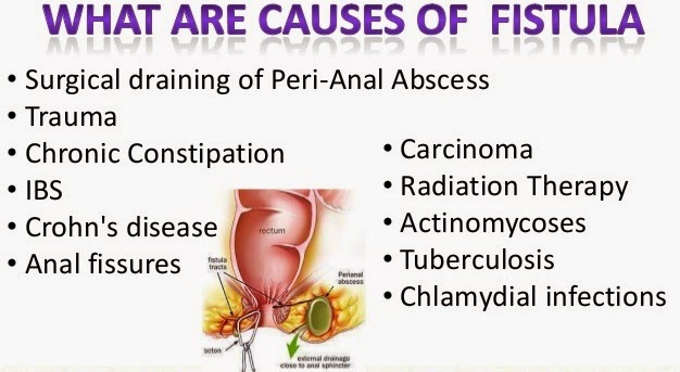 Eeshanayurveda Ayurveda Treatment For Fistula In Ano eeshanayurveda-ayurveda-treatment-for-fistula-in-ano