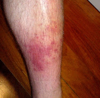 cellulitis infection on the leg