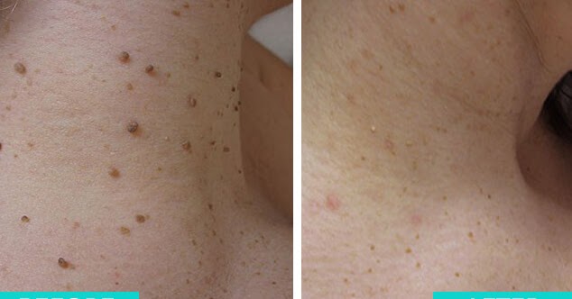 skin tag tags removal mole ugly wart does excision healing rid ways amazing bumps face wellnesstips info night feel miami