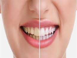 طرق التخلص من أصفرارالأسنان طرق التخلص من أصفرارالأسنان
