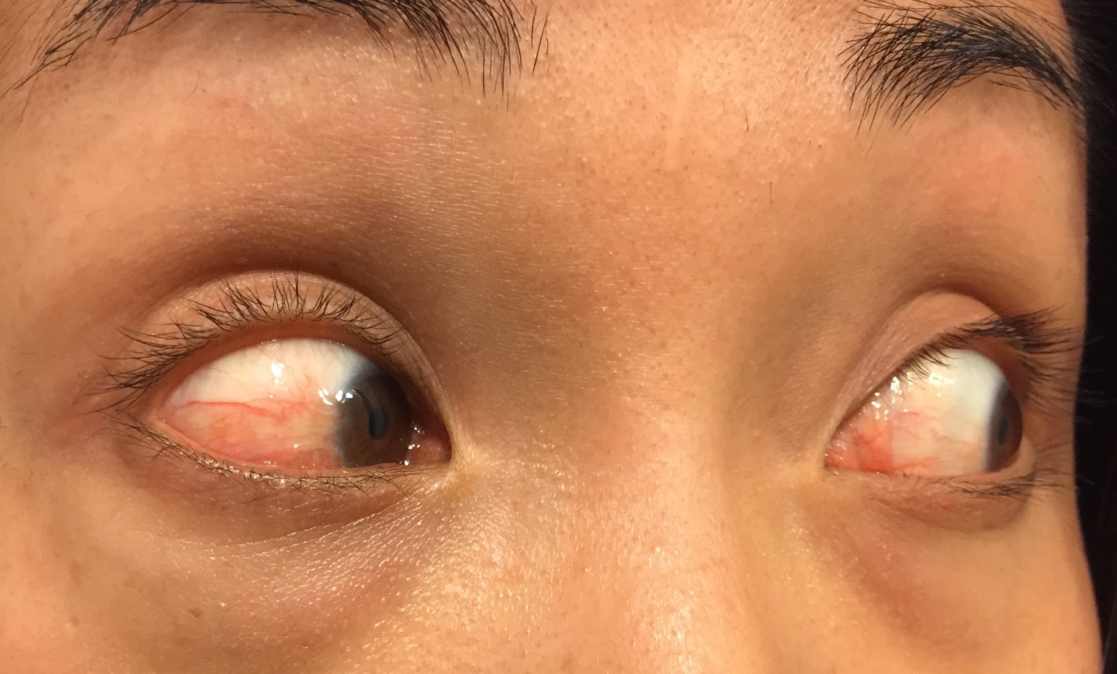 My eye Eyes 2 months of taking doxycycline (no change)