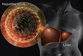 Cara Menyembuhkan Hepatitis B & C, 100% Sembuh Cara Menyembuhkan Hepatitis B & C, 100% Sembuh