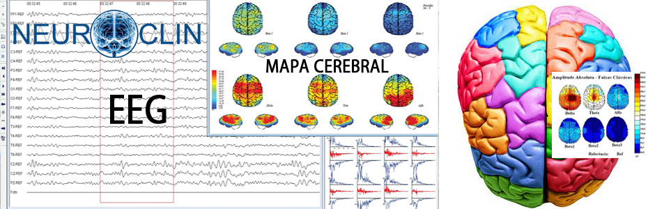 EXAMES DE: ELETROENCEFALOGRAMA (EEG) - MAPEAMENTO CEREBRAL (MC ...