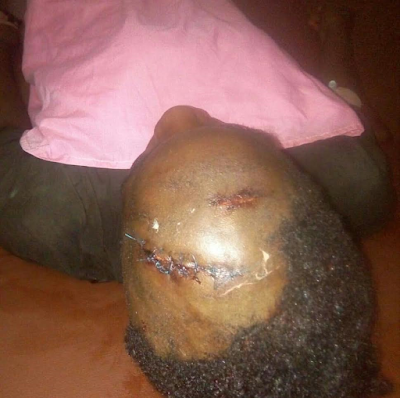 Graphic photos: 200level student of UNIBEN severely stabs her friend '5' times in the head over an argument