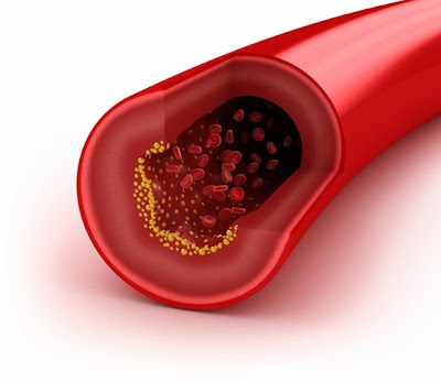 Les symptômes de l'hypercholestérolémie : tests du sang
