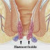 DAFTAR NAMA DAN HARGA OBAT WASIR DI APOTIK PALING AMPUH DAN AMAN thumbnail