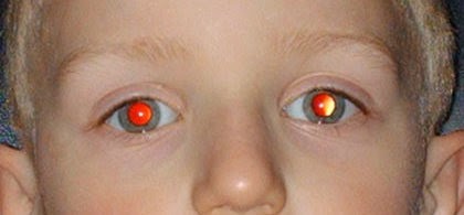 test ocular de contact