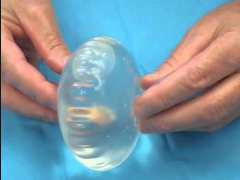 Silicone Breast Implant Complications 89