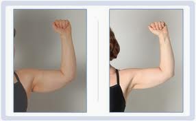 طرق التخلص من ترهلات الجلد وشده مرة اخرى