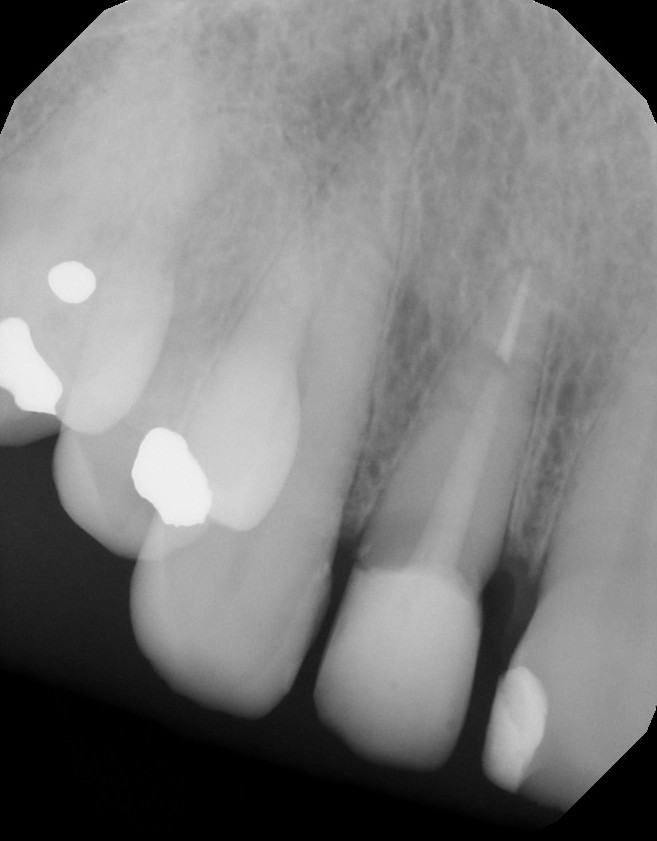 The Endo Blog Partners in Patient Care Post and Core Buildup